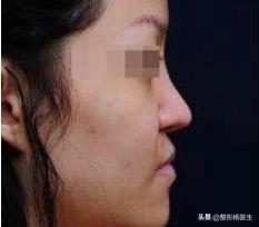 鼻基底凹陷的明星网红,揭秘他们的美丽秘诀